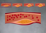 Air Pollution - a Global Threat to our Health:  - What Happens in the Rest of the Body? (07:58)